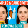Pimples Dark Spots Removal