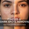 pimples and dark spots removal cream